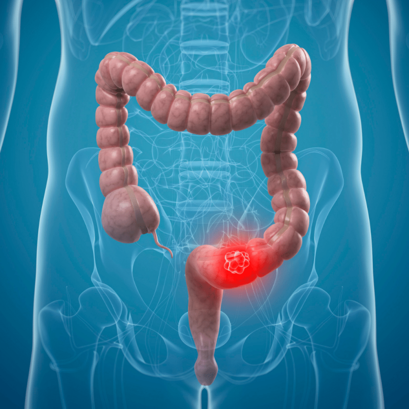 Prevención Cáncer Colorrectal Prevención Cáncer Colorrectal
